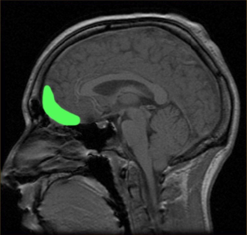 Orbitofrontal korteksin yaklaşık lokasyonu.