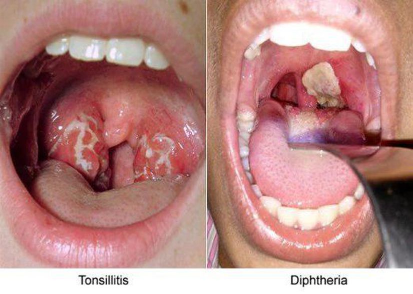 Tonsilit ve Difteri