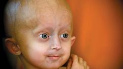 Erken Yaşlanma Hastalığı (Progeria)
