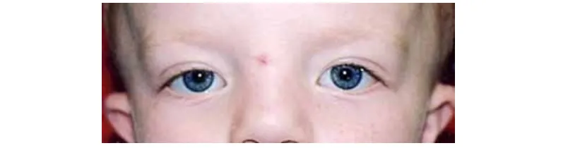 Geniş aralıklı gözler (hipertelorizm).