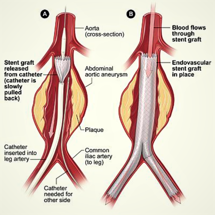 Aort anevrizmalarında cerrahi tedavi: Kullanılan stentler aort duvarına yerleştirilerek anevrizmanın tedavisi sağlanır.