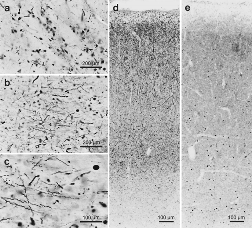 Hem kortikal (d, e) hem de subkortikal (a – c) hastalık bölgelerinde (kesit kalınlığı 100 µm) α-sinükleine karşı immünreaksiyonlarda görüldüğü gibi Parkinson hastalığı ile ilişkili lezyonlar.