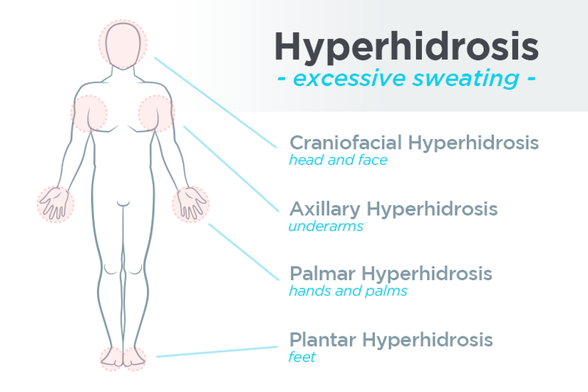 Primer hiperhidrozdan etkilenen vücut bölgeleri