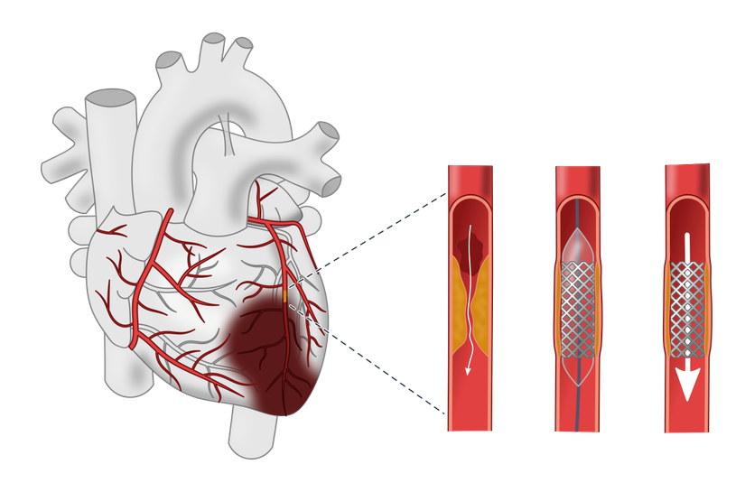 Arteri genişletmek için takılan stent.