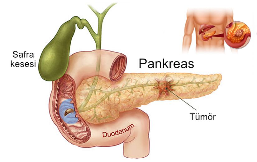 En kötü seyirli kanser çeşitlerinden biri olan pankreas kanseri.