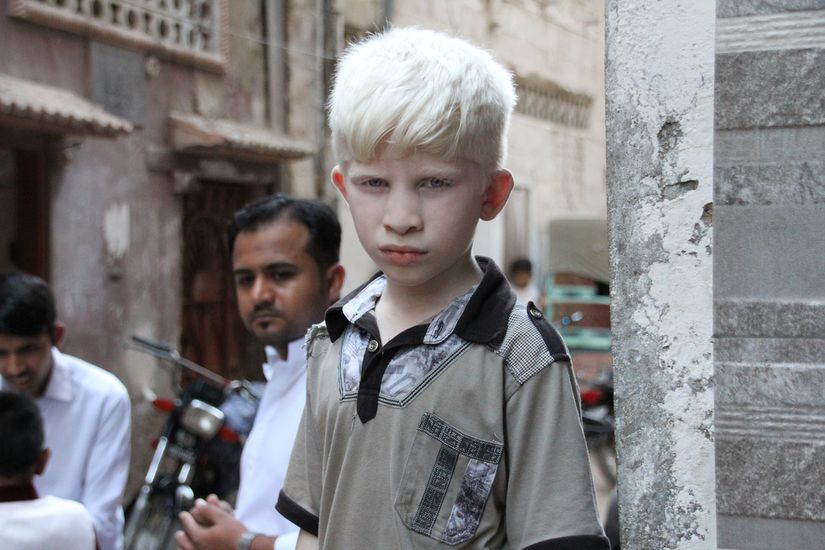 Albinizm aleli, çekiniktir. Bu çocuğun iki ebeveyni de çekinik aleli çocuğuna aktarmıştır.