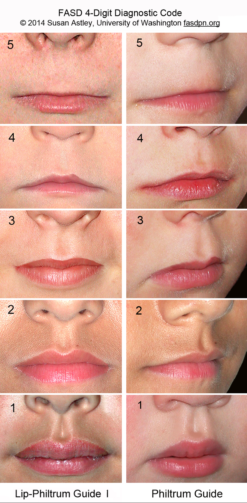 Dudak-Filtrum Kılavuzu-1, üst dudak inceliğini ve filtrum düzlüğünü sıralamak için kullanılır. 4. ve 5. sıralar Fetal Alkol Sendromu yüz fenotipini karakterize eden ince dudak ve pürüzsüz filtrumu yansıtmaktadır. 3. sıra genel popülasyon ortalamasını temsil eder.
