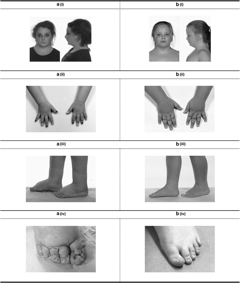 A(i) ve B(i): Turner Sendromunun bazı özelliklerini gösteren baş ve boynun ön ve yan görünümü: perdeli boyun; düşük arka saç çizgisi; düşük ayarlanmış arkaya dönük kulaklar ve geniş bir göğüs.  A(ii) ve B(ii): Eller ve parmakların iki taraflı şişmesi.  A(iii) ve B(iii): Ayak bileklerin ve ayakların iki taraflı şişmesi.  A(iv): Ayak parmakları. Papillomatoz, küçük displastik ayak tırnakları ve derin cilt kıvrım kırışıklıkları ile şişme.  B(iv): Ayak parmakları. Küçük displastik ayak tırnaklarıyla şişme.