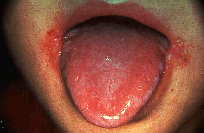 B2 vitamini eksikliği sonucunda görülen dilde inflamasyon.