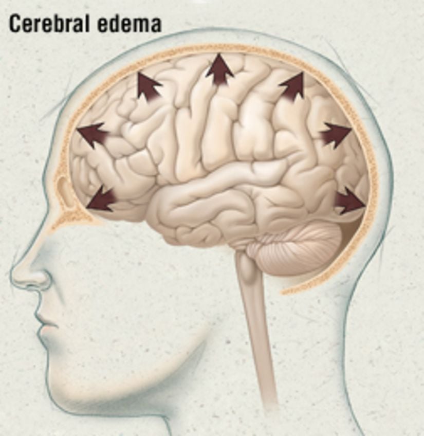 Include brain. Cerebral. High Altitudes Symptoms.