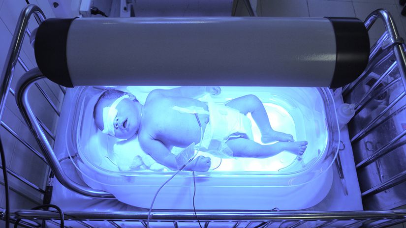 Sarılığı olan bir bebek mavi ve beyaz ışık tedavisi (fototerapi) görüyor. Bu tedavi yöntemi, bilirubini suda çözünür hale getirerek geçici olarak karaciğerin görevini yerine getirmektedir.