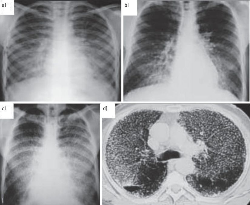 Pulmoner Alveoler Mikrolitiazis örneği