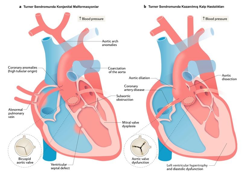 Turner Sendromunda konjenital ve kazanılmış kardiyak problemler. Kazanılmış kalp hastalıkları sıklıkla, konjenital malformasyonların üstünde meydana gelir. Örneğin, solda görülen biküspit aort kapağının mevcudiyeti aort dilatasyonu riskini artırır. Aort genişlemesi yetişkin yaşamı boyunca meydana gelir ve normals sınırı aşarsa aort diseksiyonunun öncüsü olabilir.