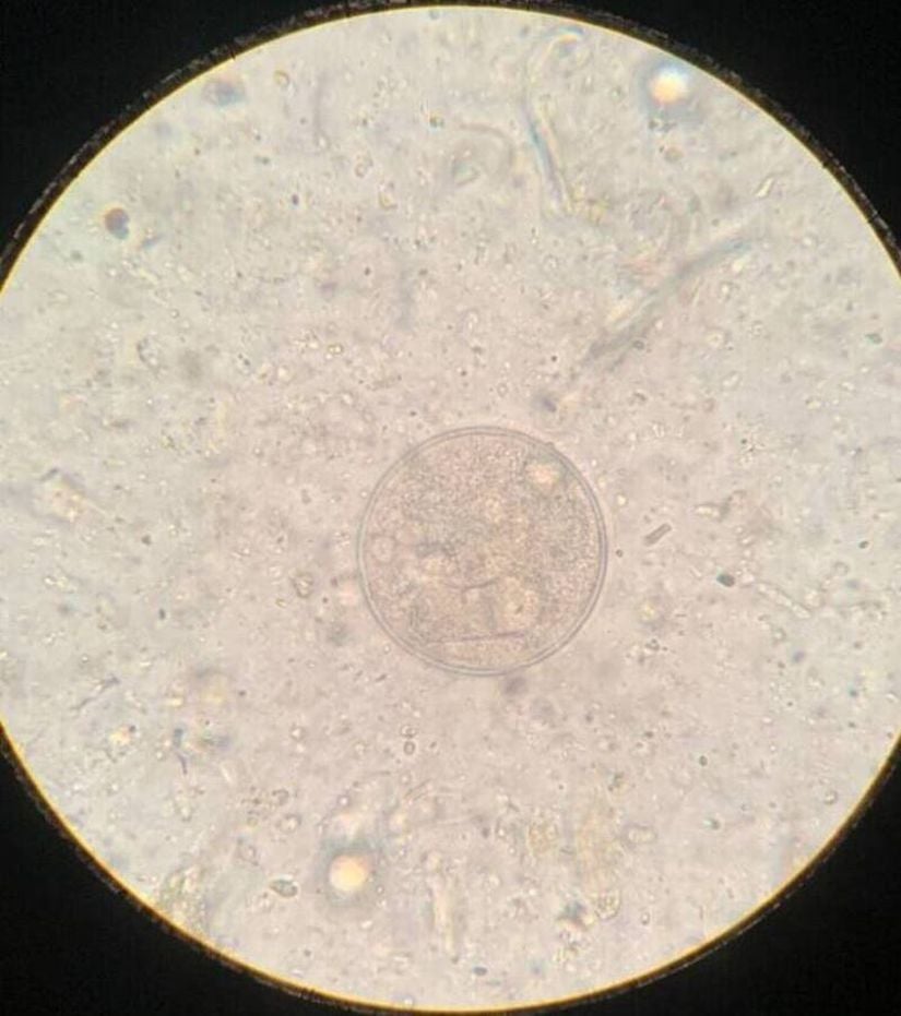 Dışkı örneğinin natif mikroskopisinde Entamoeba sp. kisti.