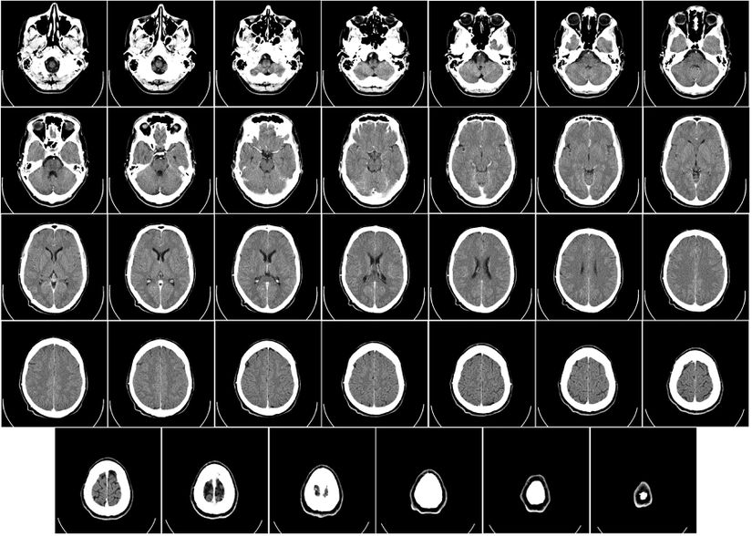 İnsan beyninin bilgisayarlı tomografisi