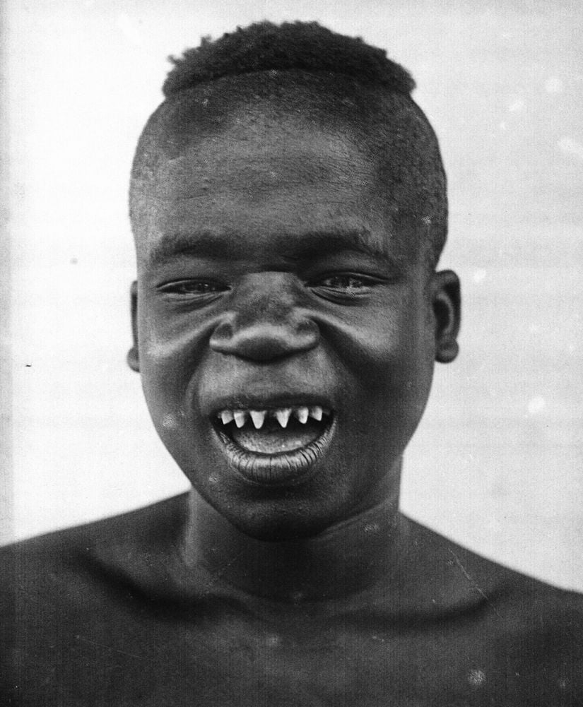 Ota Benga. Sivri dişleri, Kongo'daki genç erkekler arasında yaygın bir uygulama olan diş kazıma yöntemiyle sivrileştirilmiştir.