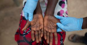 WHO Declares Mpox Not New Covid Threat