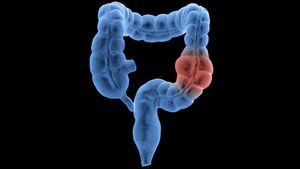 Rising Colon Cancer Rates Among Young Adults Alarm Experts