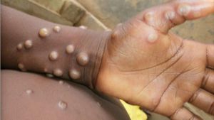 Mpox Vaccine Arrives After Long Wait In Africa