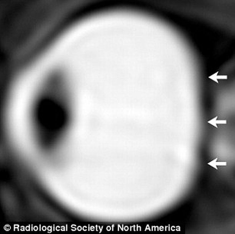 Uzay uçuşundan sonra yapılan ölçümlerde, mikrokütleçekimine uzun süre maruz kalmaktan ötürü göz yuvarının arka tarafının düzleştiği görülmektedir.