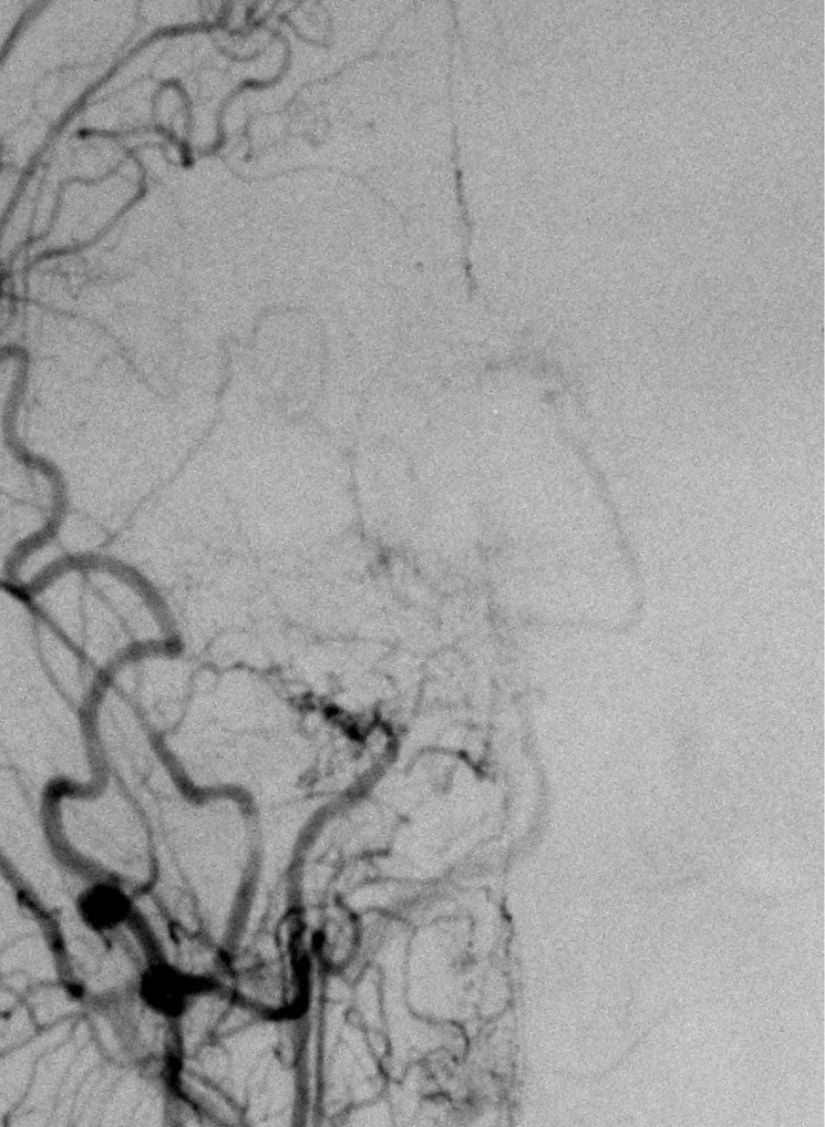 Moyamoya hastalığı olan bir hastanın sağ iç karotid arterini (ICA) gösteren bir DSA (Dijital Substraksiyon Anjiyografi) görüntüsüdür.