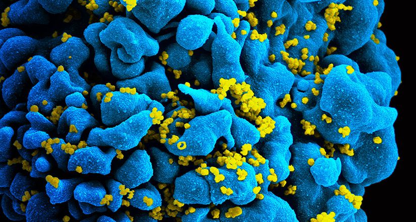 T lenfositler (mavi) üzerine tutunmuş ve sahte-renklendirme yöntemi ile görüntülenmiş HIV'ler (sarı).