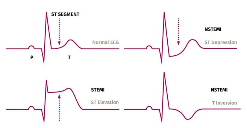 EKG okumasında STEMI ve NSTEMI