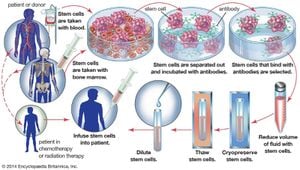 Stem Cell Transplant Transforms Type 1 Diabetes Treatment