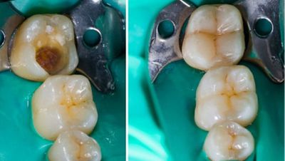Kompozit Rezin Dolgu Materyalleri Nedir? Diş Hekimliği Alanında Nasıl Kullanılırlar?