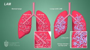 Could The Key To A Rare Lung Disease Lie In The Uterus?