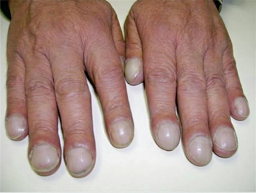 Eisenmenger sendromlu bir hastada parmaklarda çomaklaşma; ilk kez Hipokrat tarafından tanımlanan çomaklaşma &quot;Hipokrat parmakları&quot; olarak da bilinir.
