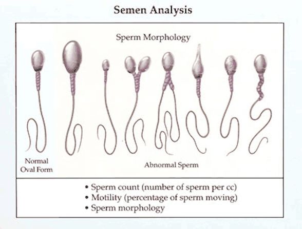 Sağlık ve saplıklık sperm şekilleri