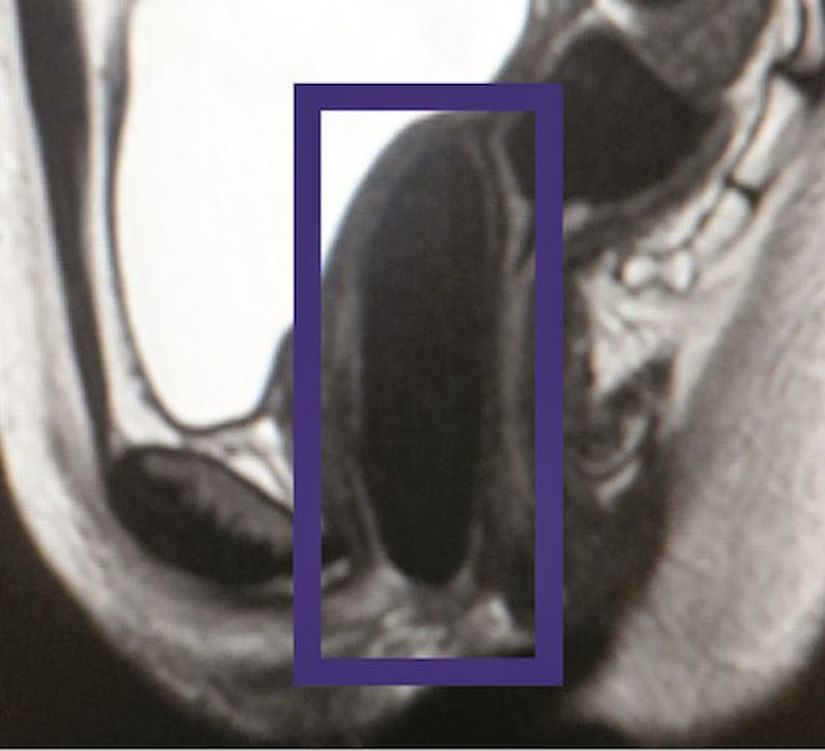 Fotoğrafta nakledilmiş bir vajinanın MRI görüntüsü görüyorsunuz.