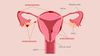 Endometriozis Nedir? Risk Faktörleri Nelerdir? Nasıl Tedavi Edilir?