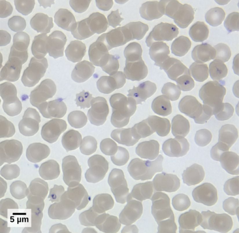 Bu ışık mikrografında P. falciparum (mor) ile enfekte kırmızı kan hücreleri 100x büyütülmüş şekilde görülmektedir.