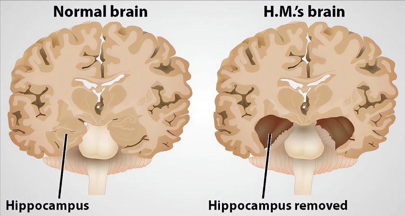 H.M.'ye ait beyin (sağ) ile normal beynin (sol) karşılaştırılması.