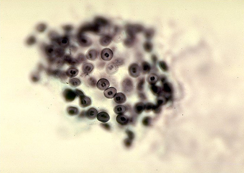 Pneumocystis jiroveci
