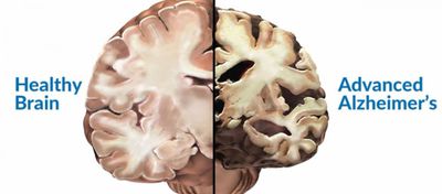 Tüm Nörodejeneratif Hastalıkların Ardında Prionlar mı Var?