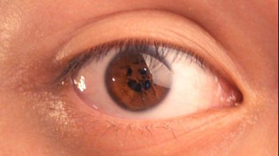 Kalıcı Gözbebeği Zarı: Bazı İnsanlarda Gözbebeği Zarı Kaybolmaz!