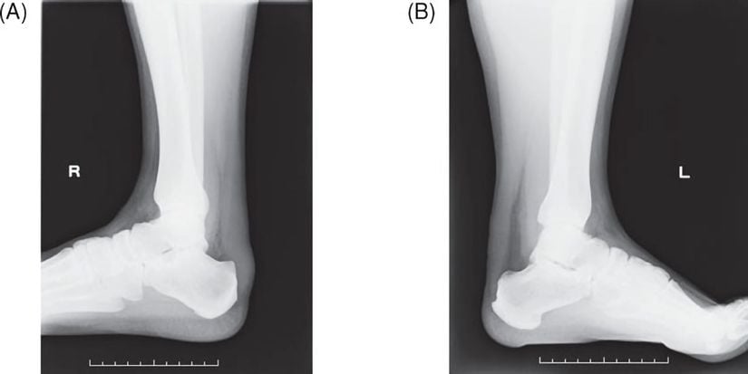 AH hastalarında Aşil tendonunun radyogramları. (A) 40 yaşında bir erkekte aşil tendonu (maksimum kalınlık: 22 mm), (B) 29 yaşında bir erkekte aşil tendonu (maksimum kalınlık: 19 mm).
