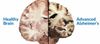 Tüm Nörodejeneratif Hastalıkların Ardında Prionlar mı Var?