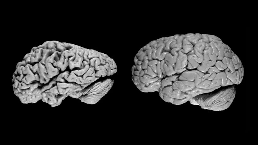 Normal beyin (sağda) ve alzheimer hastalığından mustarip kişinin beyninin (solda) karşılaştırılması