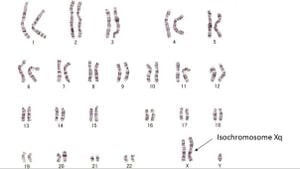 İzokromozom Nedir? Uzun veya Kısa Kolları Hatalı Kopyalanmış Kromozomlar Nasıl Oluşur?