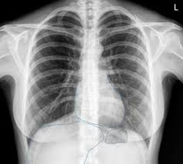 Bir akciğer röntgeni