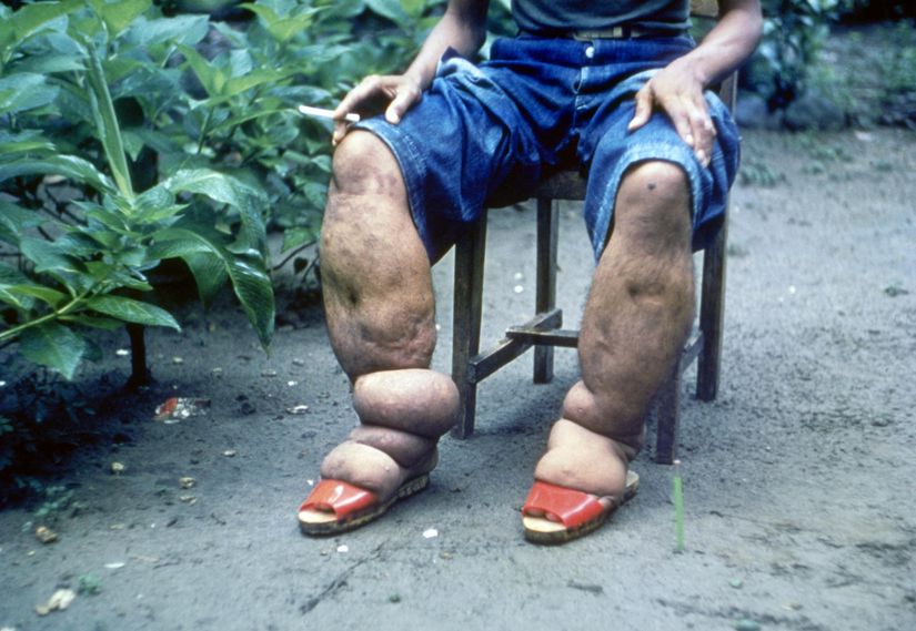 Filariasis'e bağlı bacaklarda elefantiasis (kronik ödem).