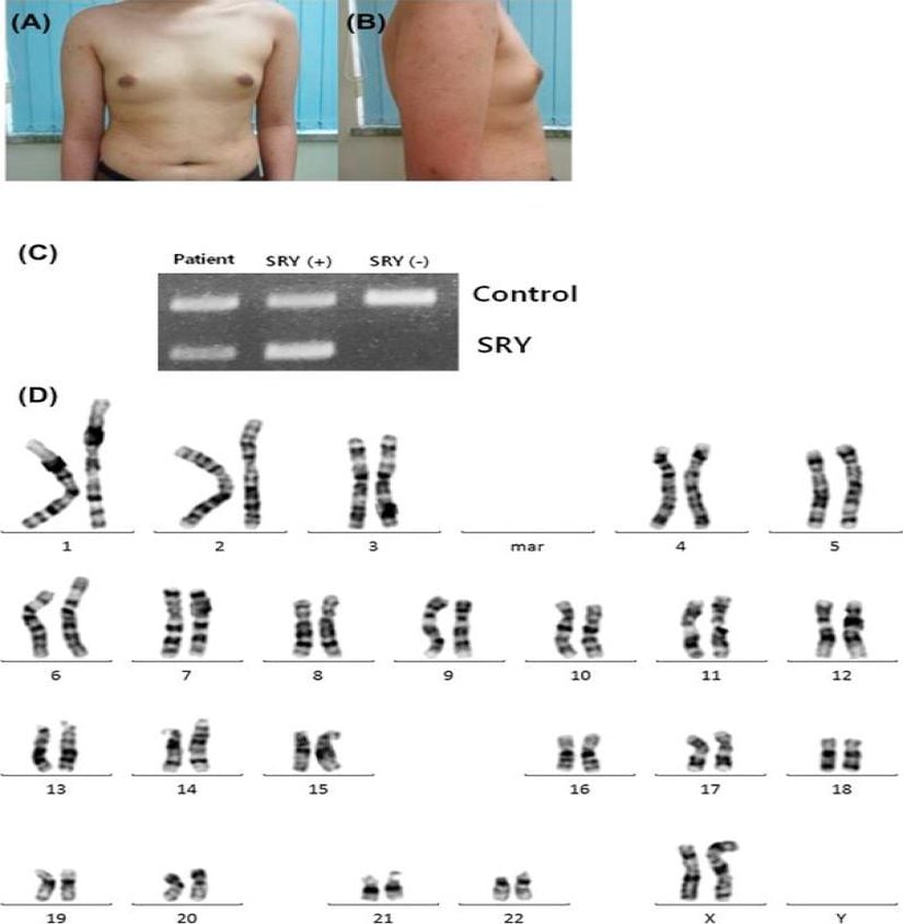 de la Chapelle sendromlu hastanın fizyolojisi , SRY protein ekspresyonu ve 46, XX karyotipi
