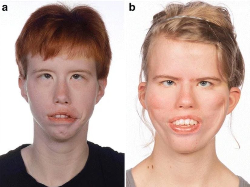 Möbius sendromuna sahip iki kadının frontal fasiyal (yüz) görüntüsü.