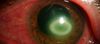 Uzun Süreli Lens Kullanımı ve Amip Temelli Hastalıklar