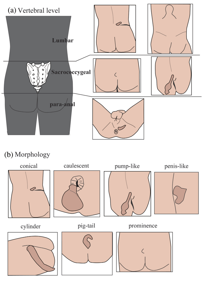 İnsan kuyruğunun çeşitliliği. (a) İnsan kuyruğu, konumuna göre üçe ayrılabilir: lumbar, sacrococcygeal ve para-anal. (b) İnsan kuyruğunun morfolojisi ciddi bir şekilde çeşitlilik göstermektedir.