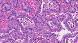 New Multi-Classifiers Predict Recurrence Of Kidney Cancer With High Accuracy